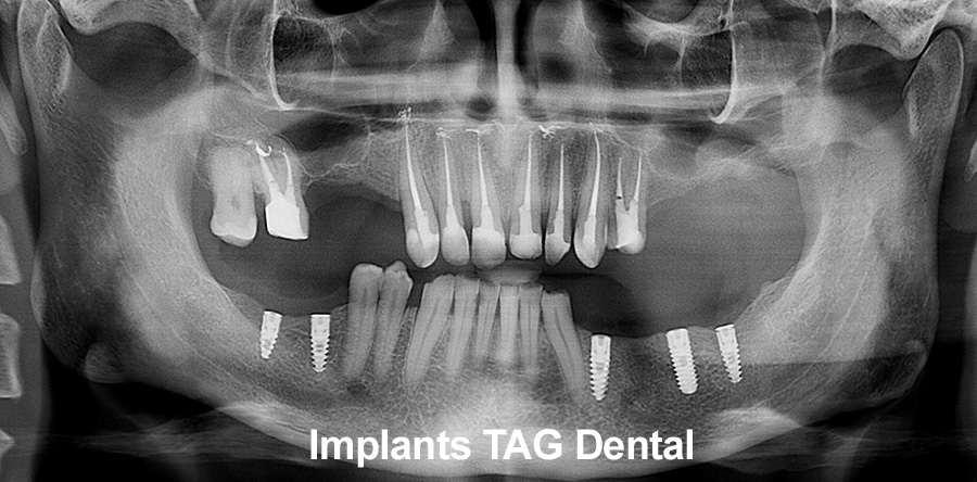 Implant_dinte_proteza_implantare_stomatolog
