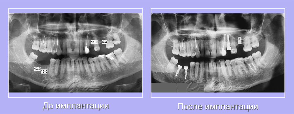 импланты_протезист_болит_стоматолог_Евгений