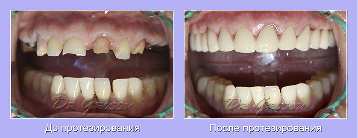Диоксид_циркония_протезист_Евгениий_Гроссу
