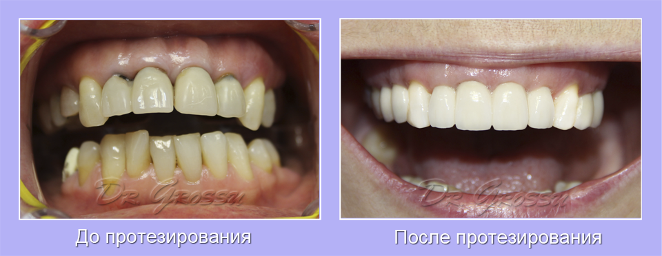 Цирконий_,безметалловая керамика_клиника_Гроссу_стоматология Кишинев